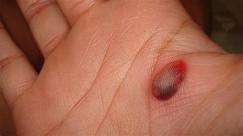 Blood Blisters Symptoms Causes And Treatment