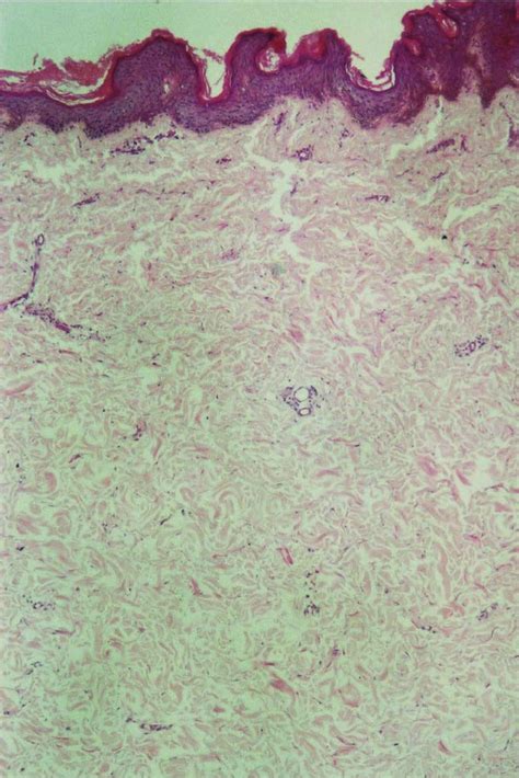 Histopathological Findings Acanthosis Hyperkeratosis And Absence Of