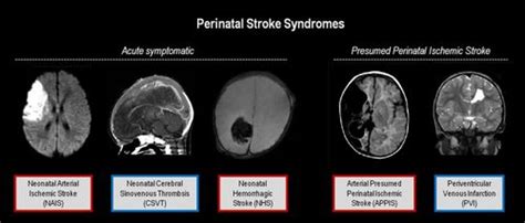 Life After Perinatal Stroke Stroke
