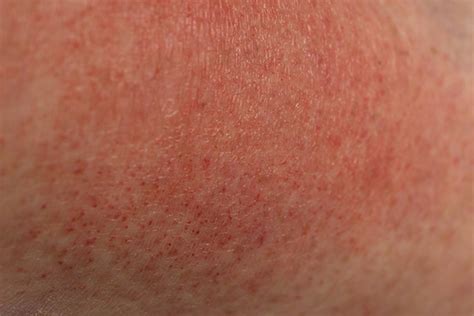 What Is A Heat Rash On Skin