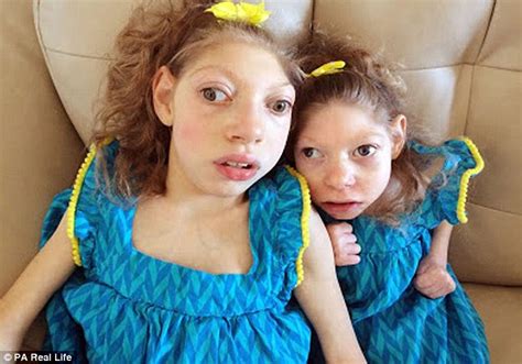 Mother Of Daughters With Rare Condition Linked To Zika Virus Insists