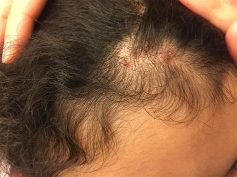 It is worthwhile to know that ingrown hair cyst is mostly found on the scalp. What is scalp folliculitis? Can it be treated? - Quora