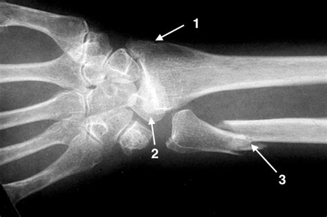 Dislocation Wrist Lunate Hand Surgery Source