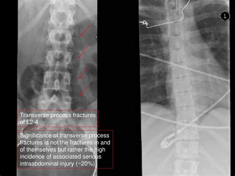 L2 L3 Transverse Process Fracture