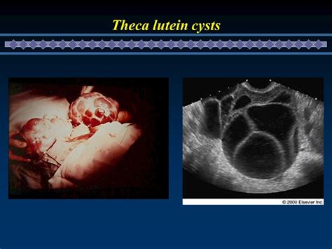 Theca Lutein Cysts Cysts Lutein Radiology