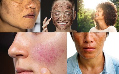 Blotchy Skin Know Its Causes And Effective Solutions Reequil