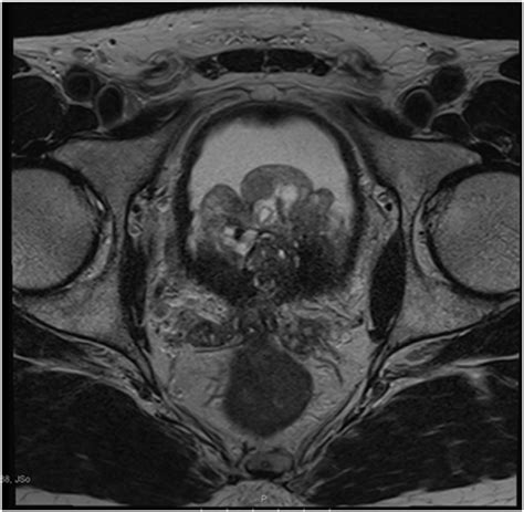 T2 Weighted Mri Scan Axial View Shows The Regrowth Of The Prostate