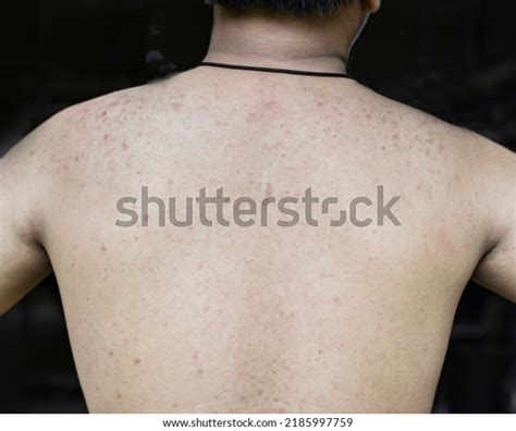 Dermatitis Rash Red Bump On Skin Stock Fotografie 2185997759 Shutterstock