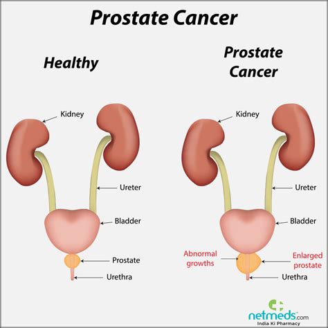 Human Genome Project What Are Signs Of Prostate Cancer
