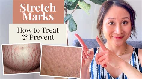How To Treat And Prevent Stretch Marks And The Products I Use Dr