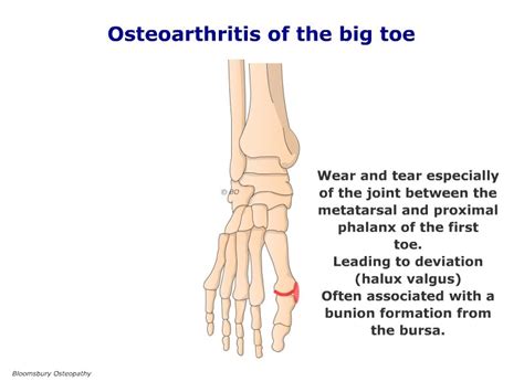 Big Toe Osteoarthritis Fotp08 Bloomsbury Health Centre