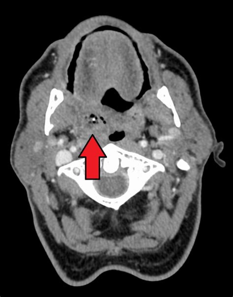 Peritonsillar Abscess Wikem