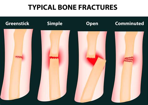 A Focus On Orthopedic Surgery How Long Do Broken Bones Take To Heal
