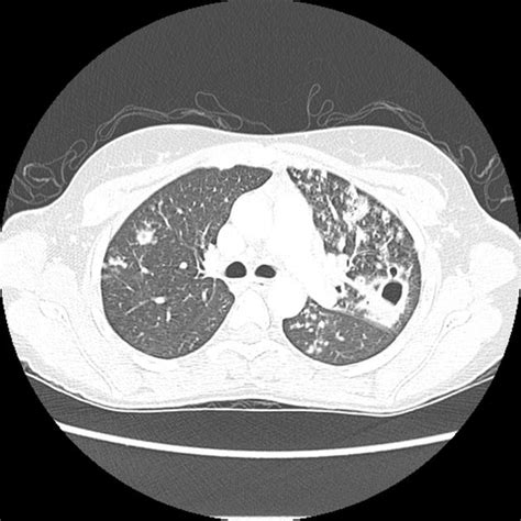 Multi Drug Resistant Tuberculosis Ct Wikidoc