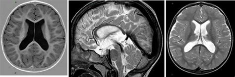Fig S17 Mri Scans Hypoplasia Of The Corpus Callosum Dilated Lateral