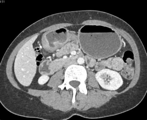 Infiltrating Carcinoma Of The Gastric Antrum Stomach Case Studies