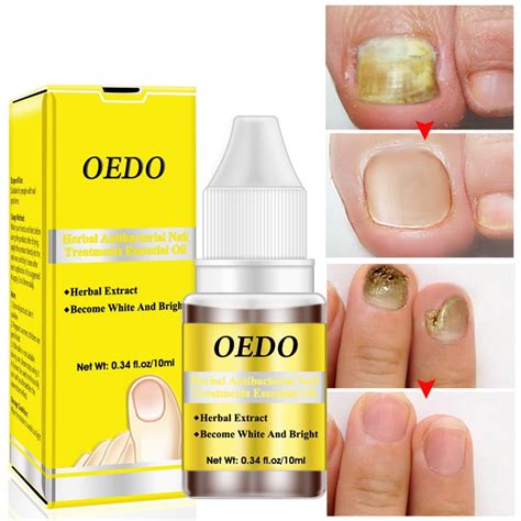 Psoriasis Nail Oil Treatment Toenails Fingernails Skin Treatment 0