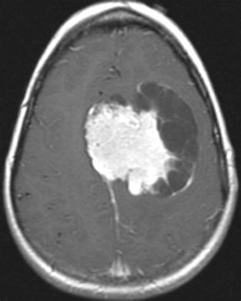 Meningioma Mri Wikidoc