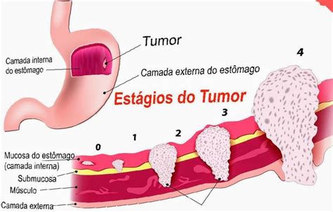 Estágios Do Tumor Anatomia Umana Anatomia