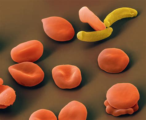 Malarial Parasites Photograph By Eye Of Science Pixels