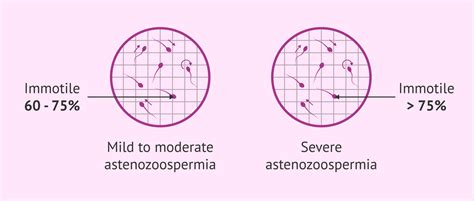What Is Asthenozoospermia Definition Causes And Treatment