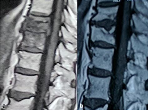 Healing In Potts Spine Is Associated With Reduction In T1