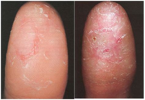 Finger Eczema Causes Dorothee Padraig South West Skin Health Care