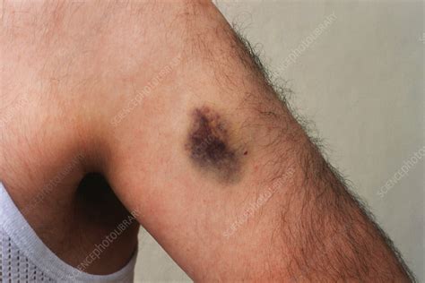 Bruise On Arm Stock Image C0270661 Science Photo Library