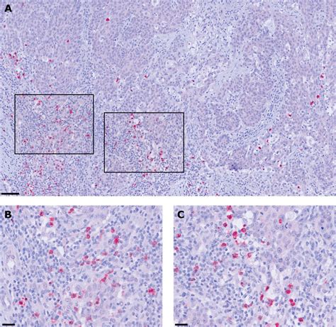 Tumor Infiltrating Plasmacytoid Dendritic Cells Are Associated With Survival In Human Colon