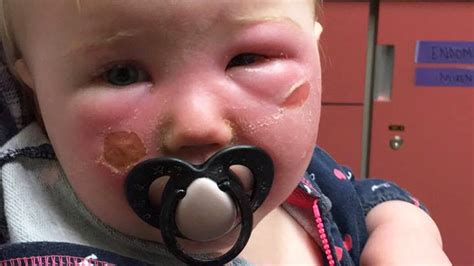 These rashes can be scary, particularly when they appear on children. Mom warns about sunscreen after toddler ends up in ER with bad reaction - TODAY.com
