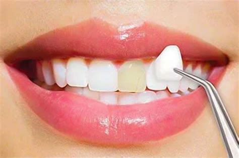 ¿qué Son Las Carillas Dentales Y Qué Ventajas Tienen ClÍnica MuÑoz