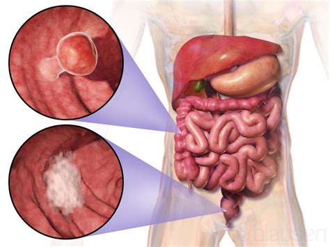 The colon is the final part of the digestive tract. Colon/ Rectal Cancer: Risk Factors (Red Meat?), Stages ...