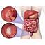 Colon/ Rectal Cancer Risk Factors Red Meat Stages Survival 