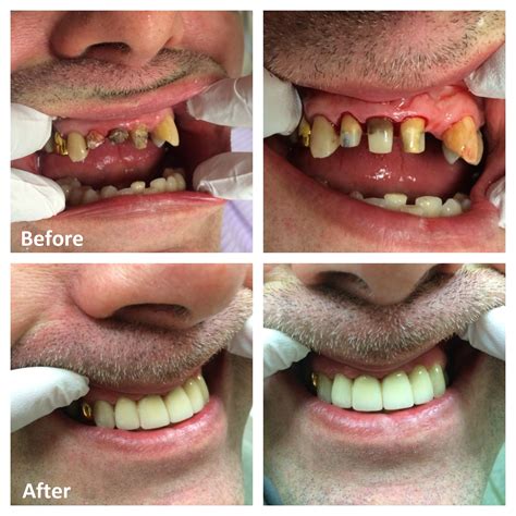Tooth Crowns And Dental Bridges Ottawa Restorative Dentistry