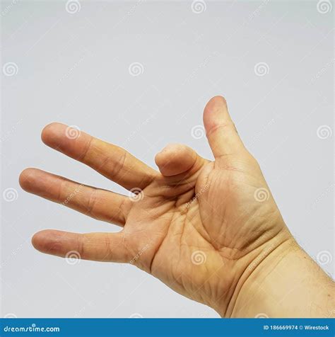 Hand Of A Person With A Part Of The Index Finger Missing Due To A Prior