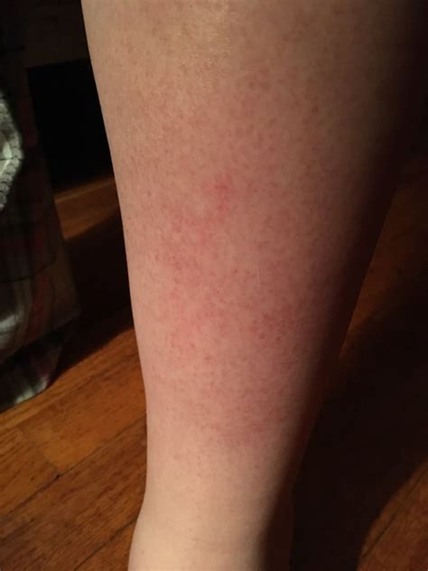 Red Patches On Lower Leg 365 Weeks Glow Community