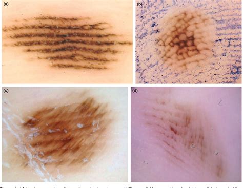 Key Points In Dermoscopic Differentiation Between Early Acral Melanoma
