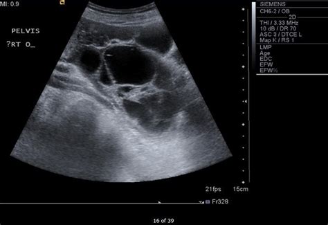 Ovarian Cancer Ultrasound Of Ovaries With Cyst Sonographic Assessment