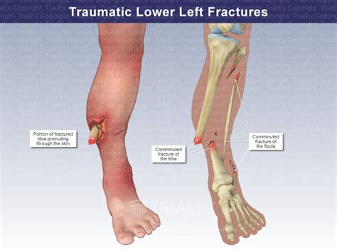 Traumatic Lower Left Leg Fractures Trial Exhibits Inc