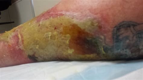 Bubbamikes Ramblings Cellulitis Warning Graphic Photos In This Post