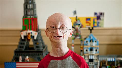 Progeria Syndrome Facts Symptoms Causes Treatment Home Remedies