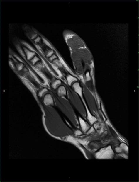 Giant Cell Tumor Of The Tendon Sheath Hand Musculoskeletal Case