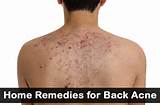 Back Acne Home Remedies Fast Pictures