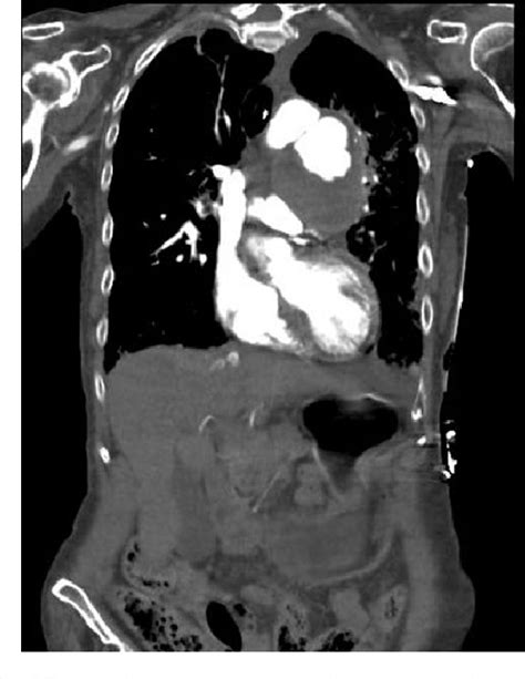 PDF An Interesting Case Of An Aortopulmonary Artery Fistula