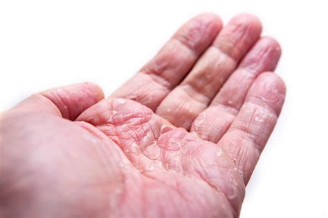 Eczema On Hands Pictures