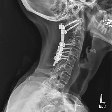 Post Operative T2 Weighted Axial Mri Of The Cervical Spine Download