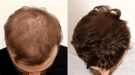 Hair Loss In Men Nyc Ny True And Dorin Medical Group