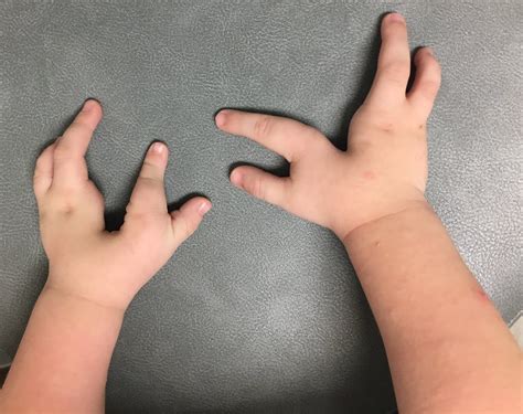 Untreated Cleft Hand Congenital Hand And Arm Differences
