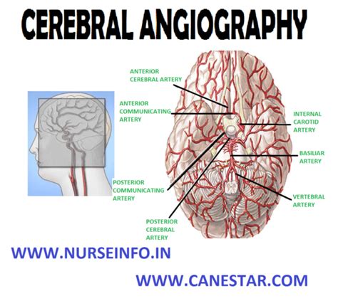 Cerebral Angiography Nurse Info