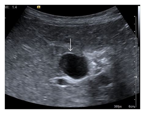 Ultrasound Image Of The Cystic Duct Cyst A The Cystic Duct Cyst At